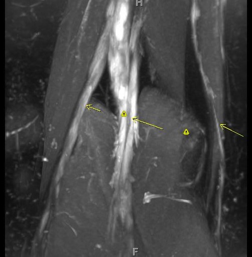 Figure 5 for case Charcot Marie Tooth Type 1a